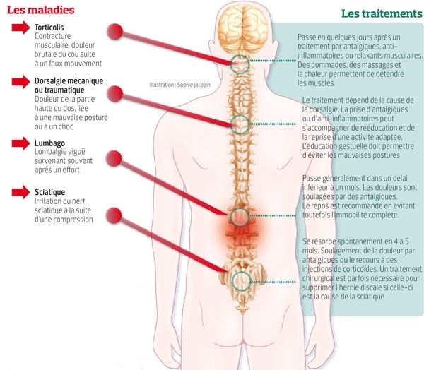 Mal de dos musculaire : Comment réagir